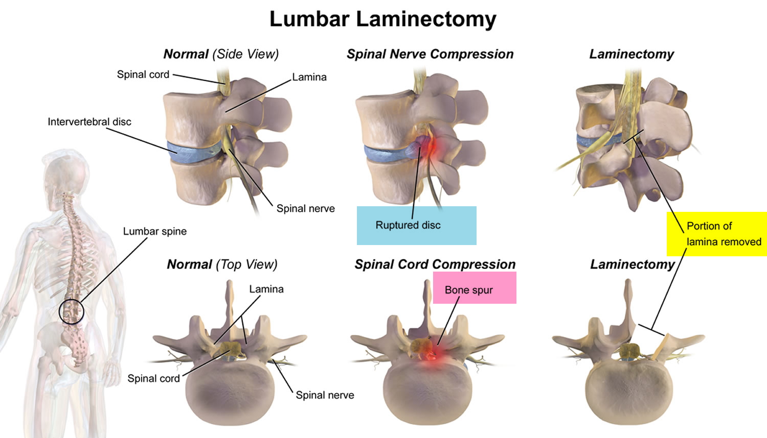 Laminectomy Surgery Recovery And Laminectomy Complications 