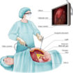 laparoscopy procedure