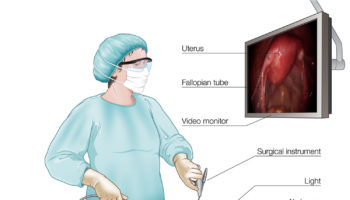laparoscopy procedure