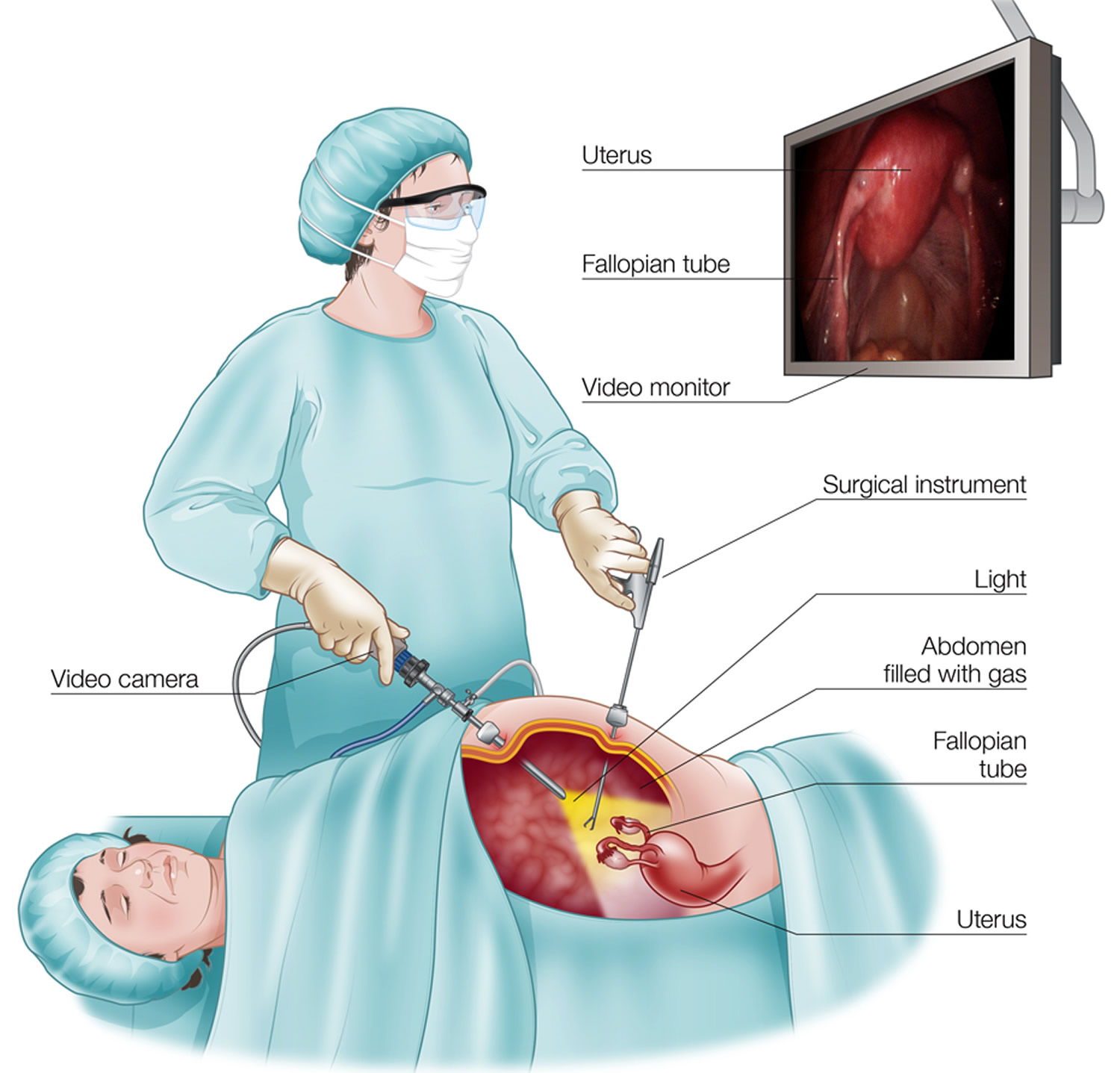 Surgery of Fallopian tube