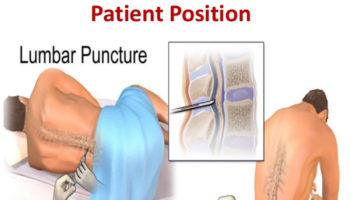 lumbar puncture