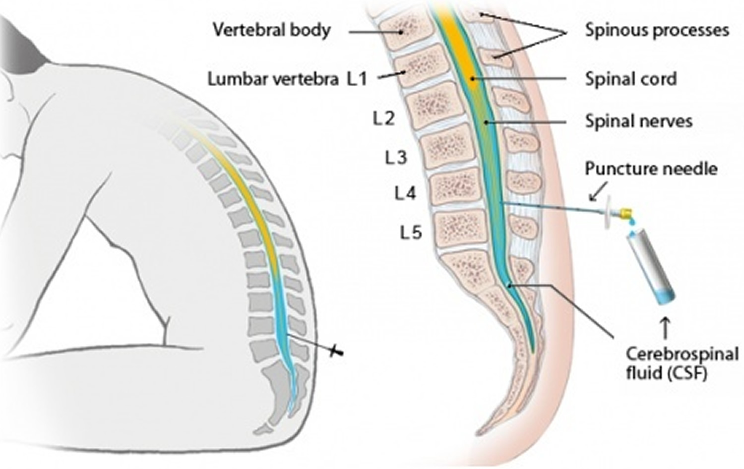 lumbar puncture position