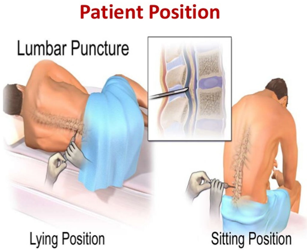 How To Relieve Back Pain After Lumbar Puncture