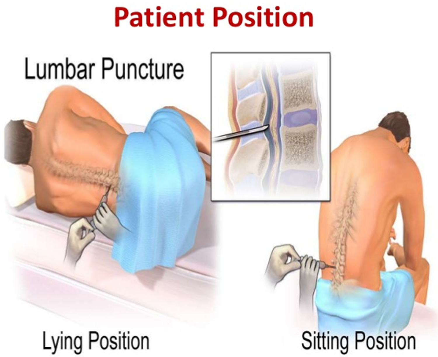 Lumbar Puncture Position 