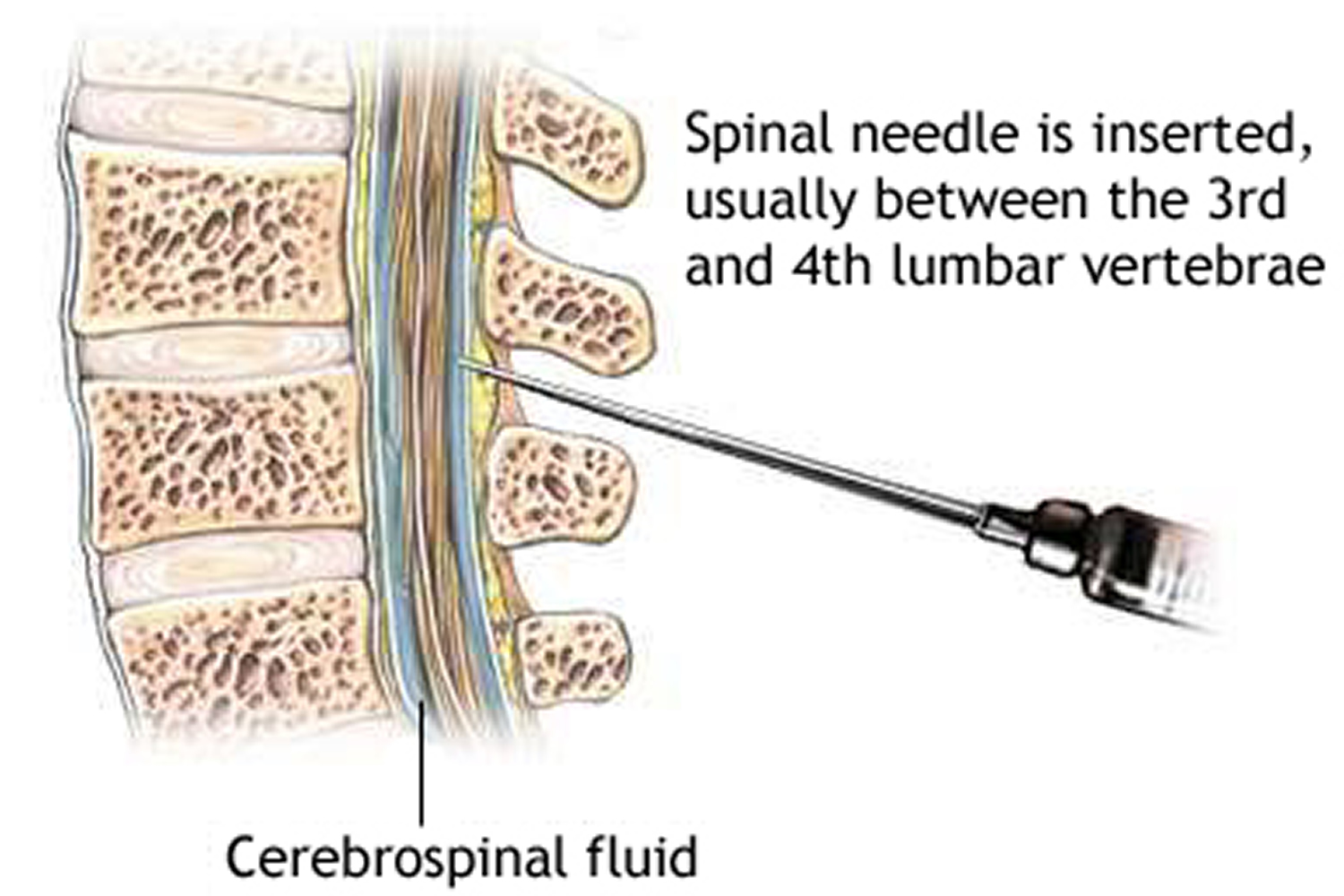 Iliac Crest Lumbar Puncture