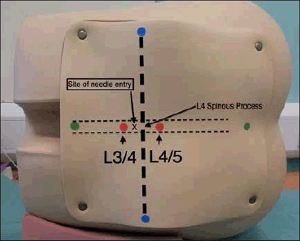 Lumbar Puncture Procedure Position And Lumbar Puncture Side Effects