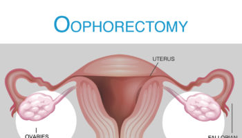 oophorectomy