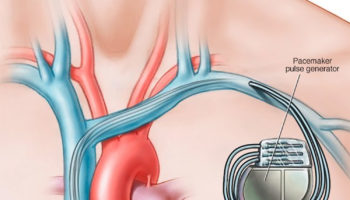pacemaker