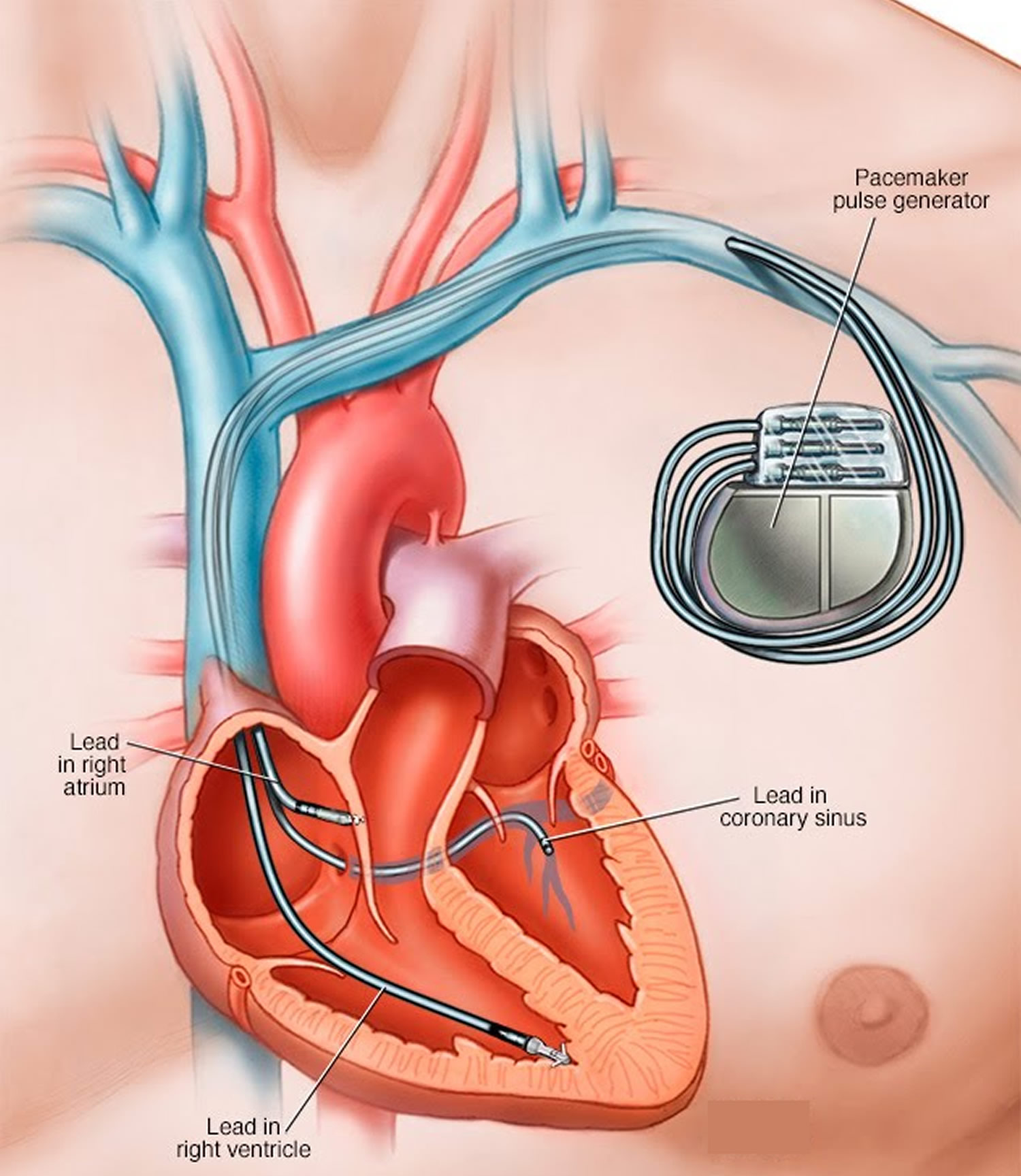 Pacemaker Heart Pacemaker Indications How A Pacemaker Work