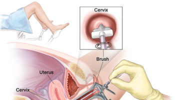pap smear