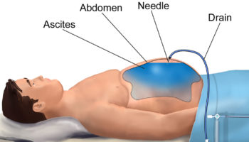paracentesis
