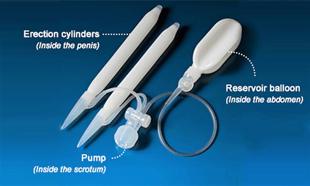 Penile Implant - Penile Prosthesis Implant, Surgery, Complications