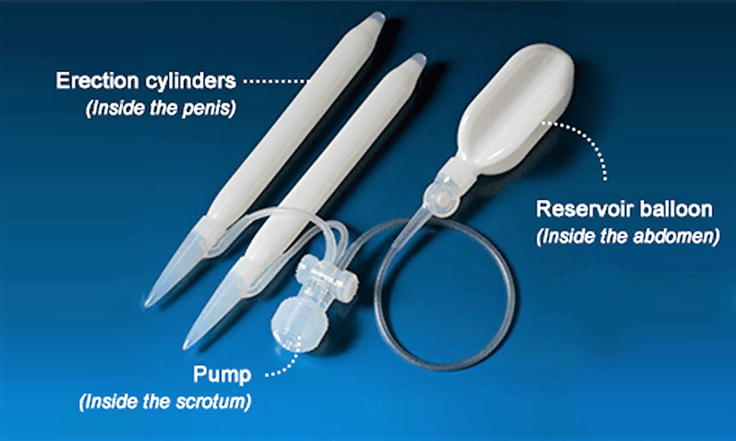 penile implant pump