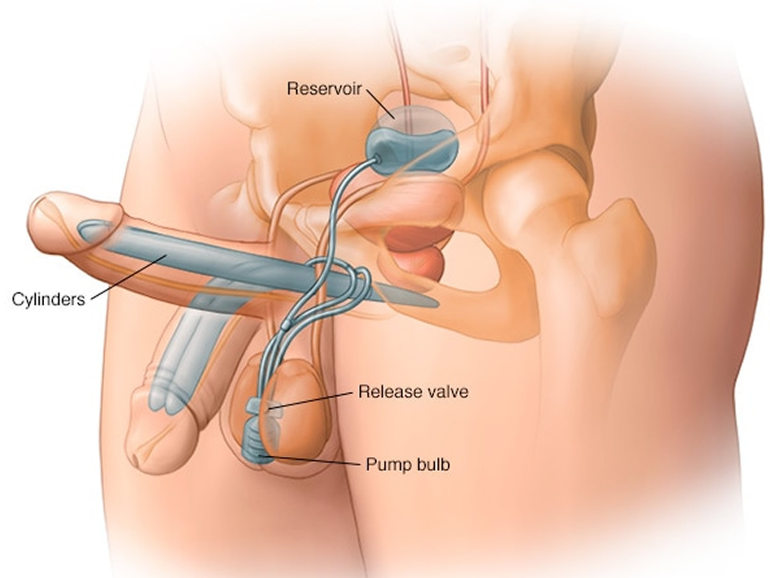 penile implant three-piece
