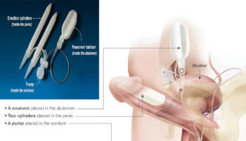 penile prosthesis implant