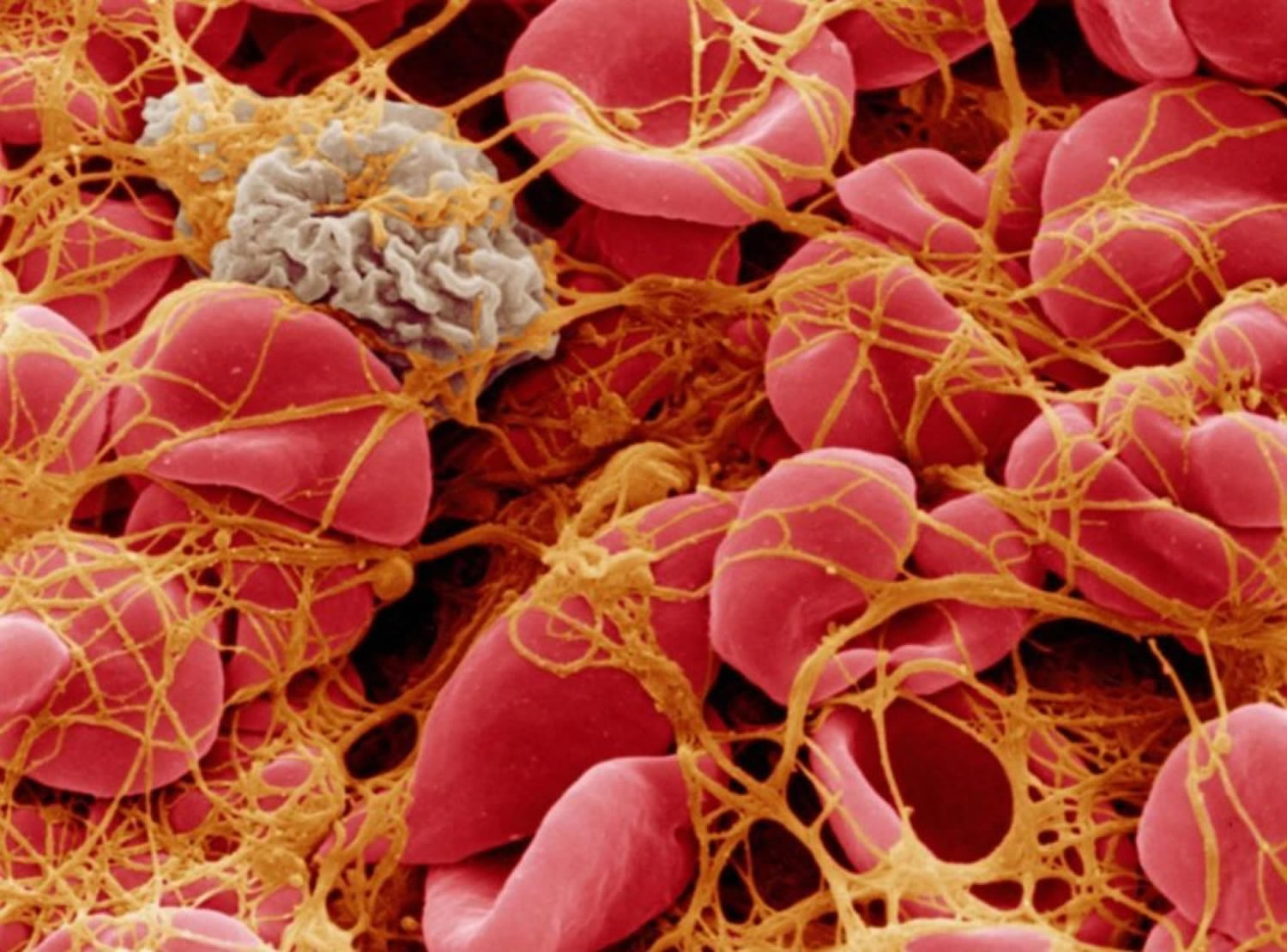 What Does High Platelets Indicate