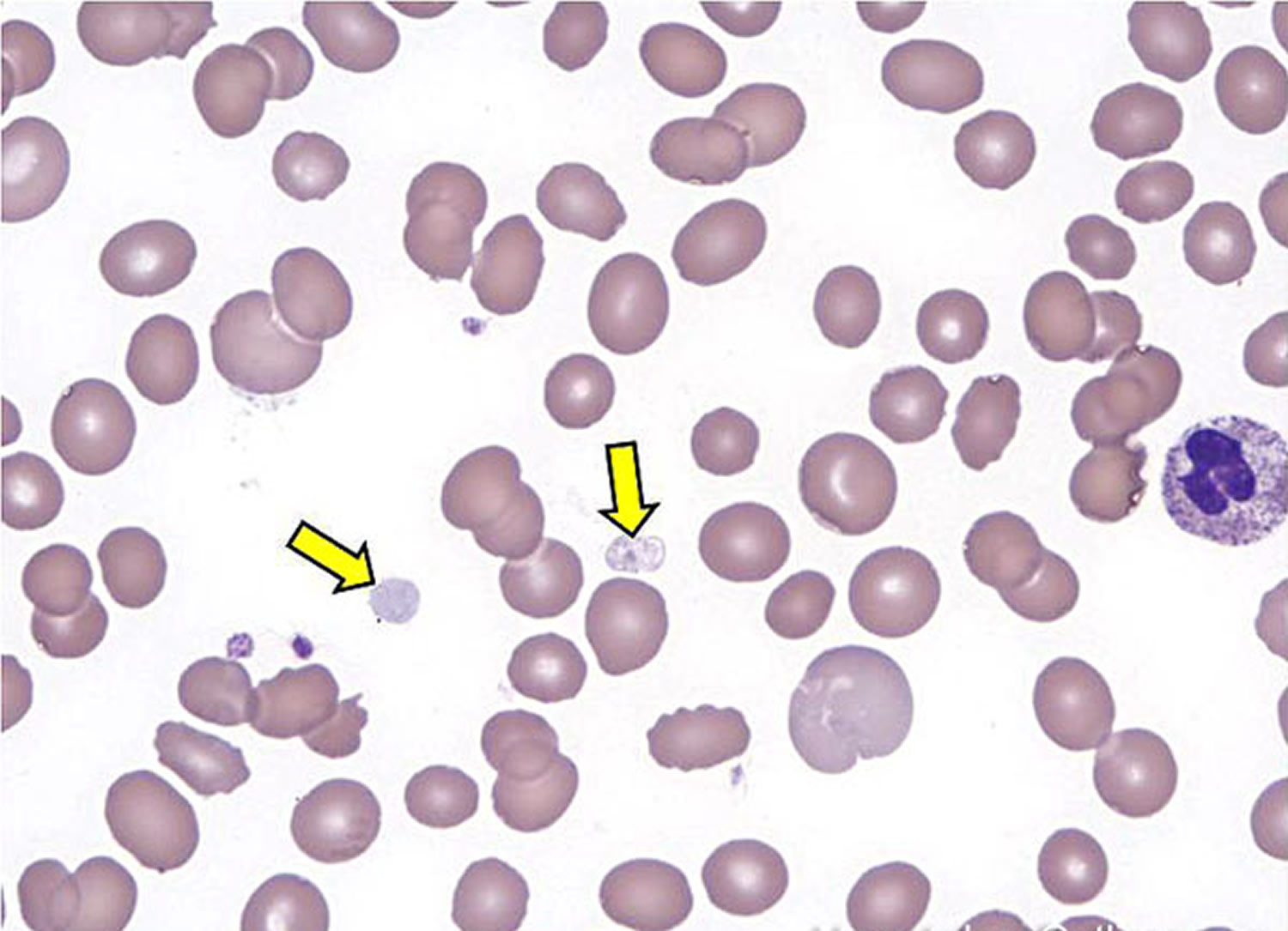 Platelet Count - High & Low Platelet Count, Causes & Treatment