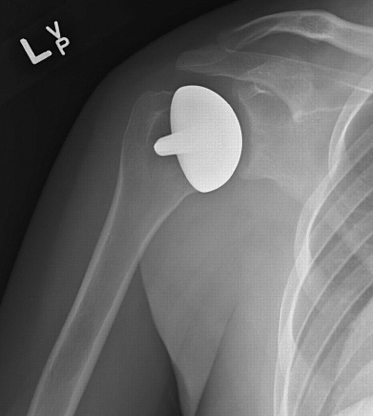  shoulder resurfacing arthroplasty