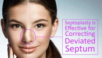 septoplasty