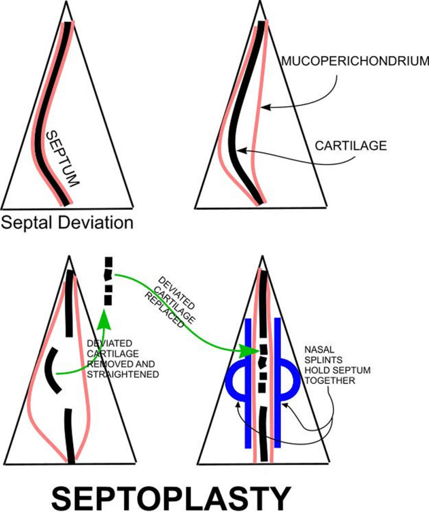 Septoplasty Surgery Recovery Time & Complications