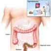 sigmoidoscopy