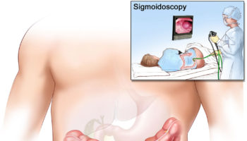 sigmoidoscopy