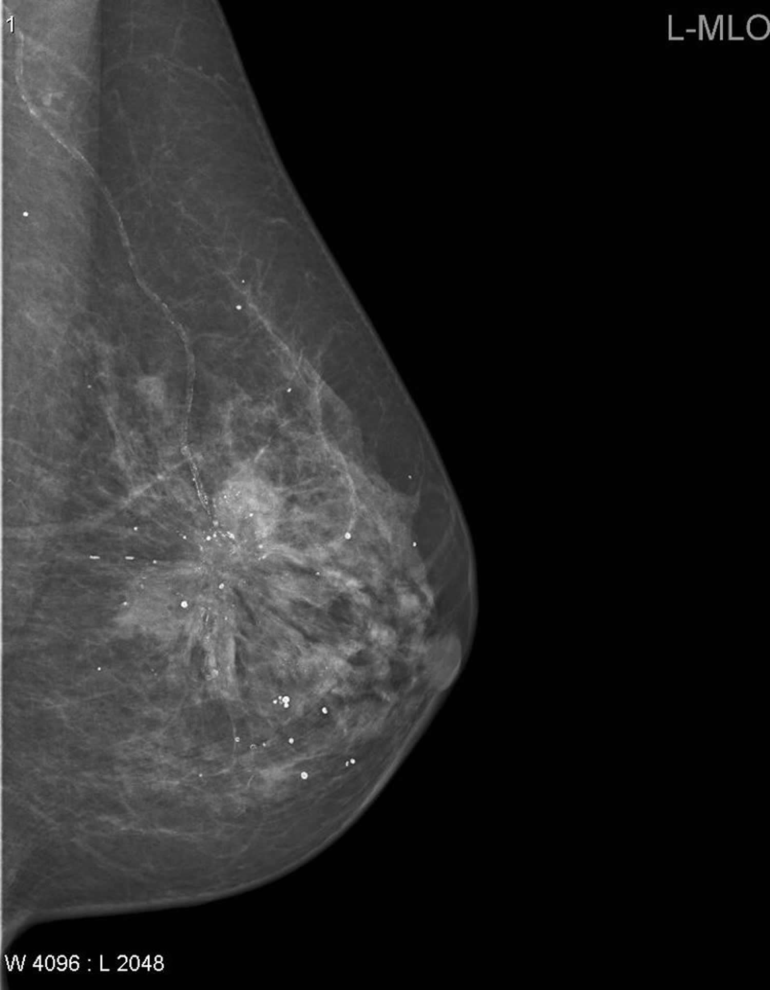 Spiculated breast cancer mammogram