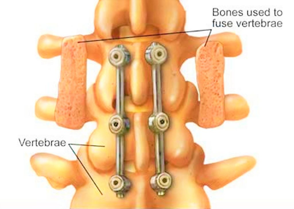 Laminectomy Surgery Recovery And Laminectomy Complications 7050