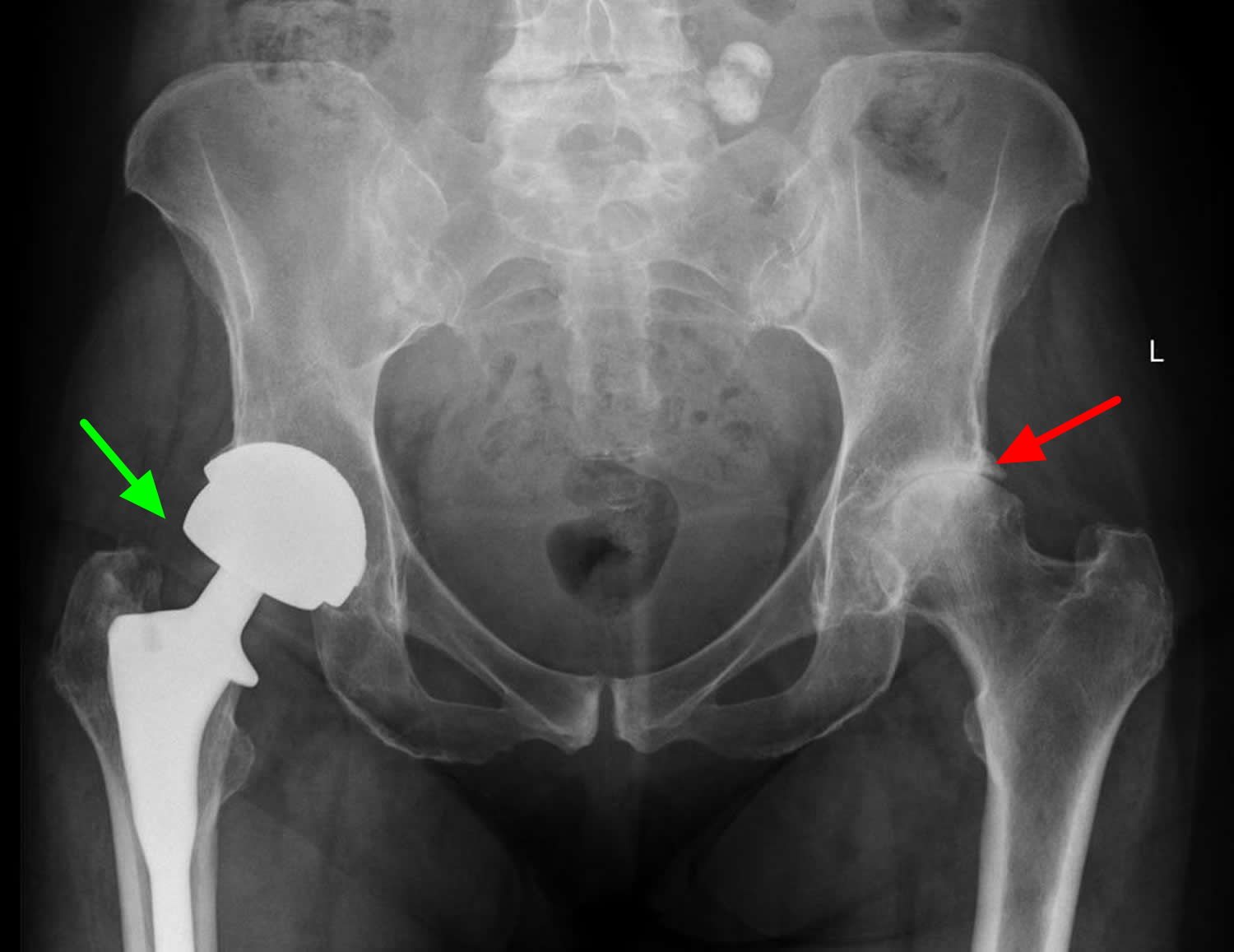total hip replacement x-ray
