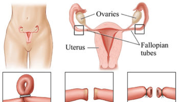 tubal ligation