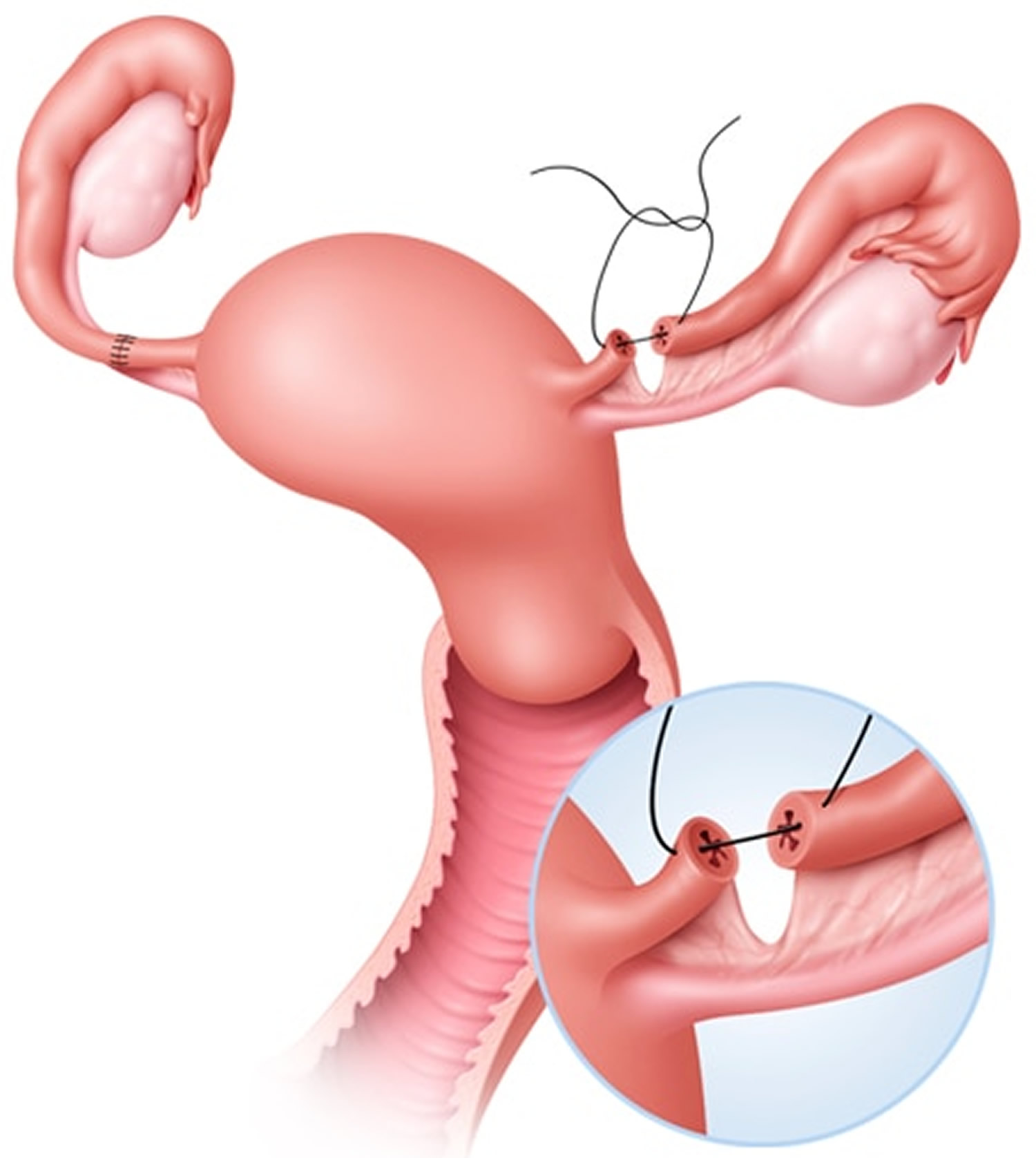 Женская стерилизация (перевязка маточных труб)