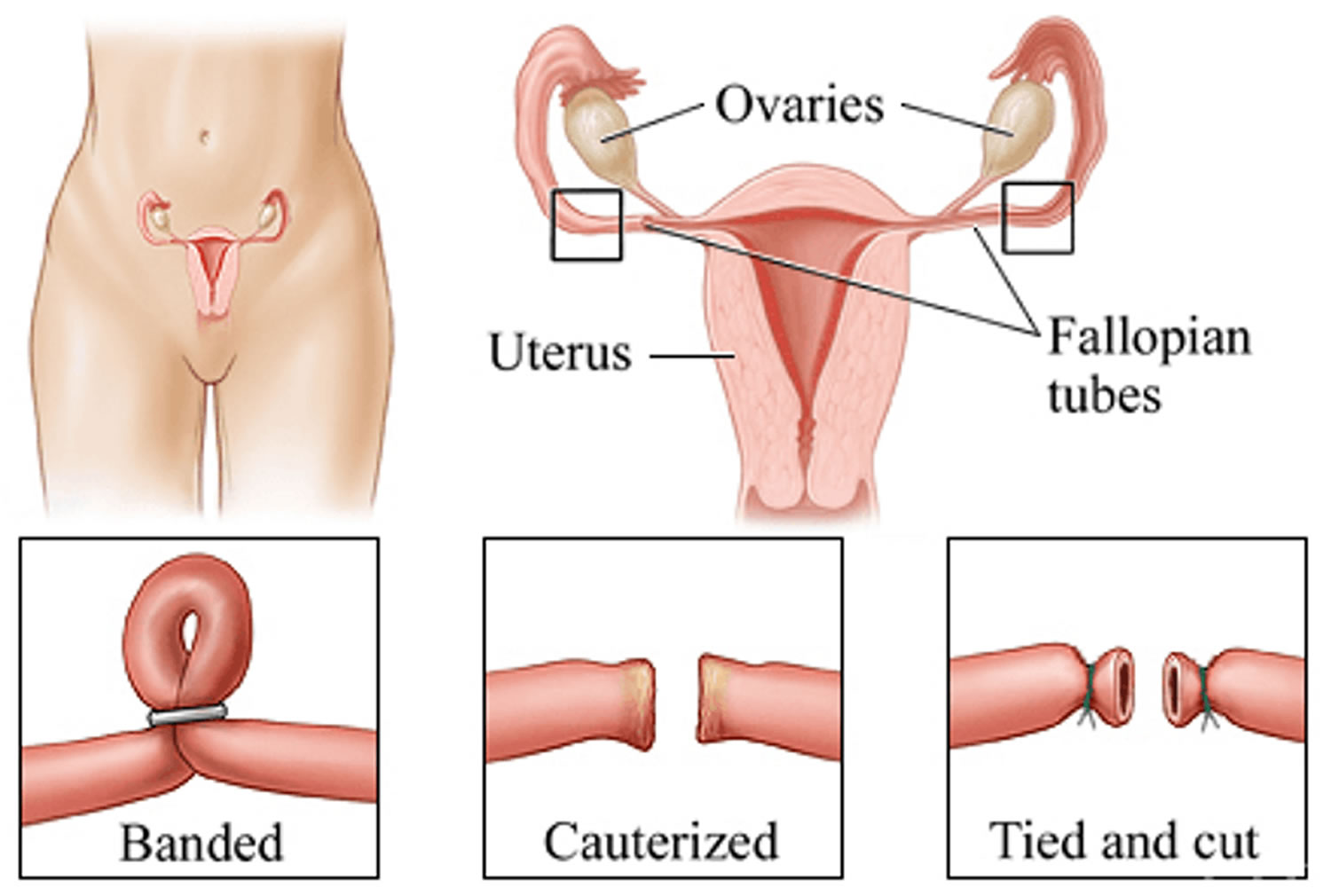 Vasectomy vs. tubal ligation: Understanding the options