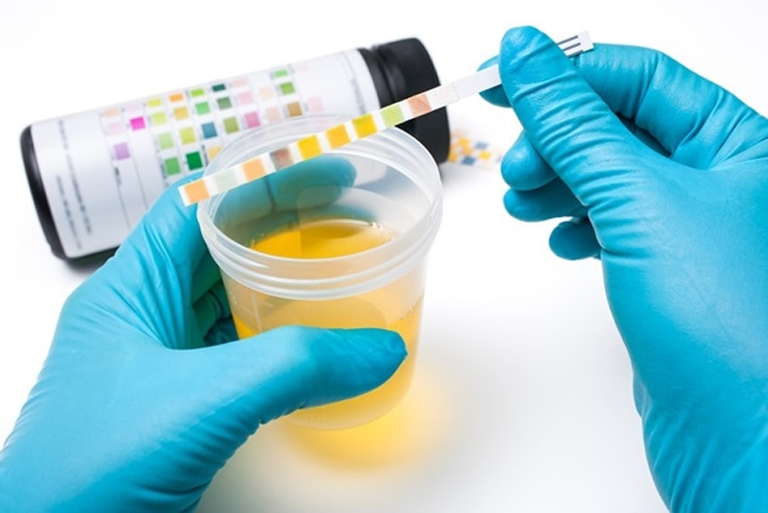 Urinalysis What Does An Urinalysis Test For, How to Interpret Results