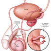 vasectomy
