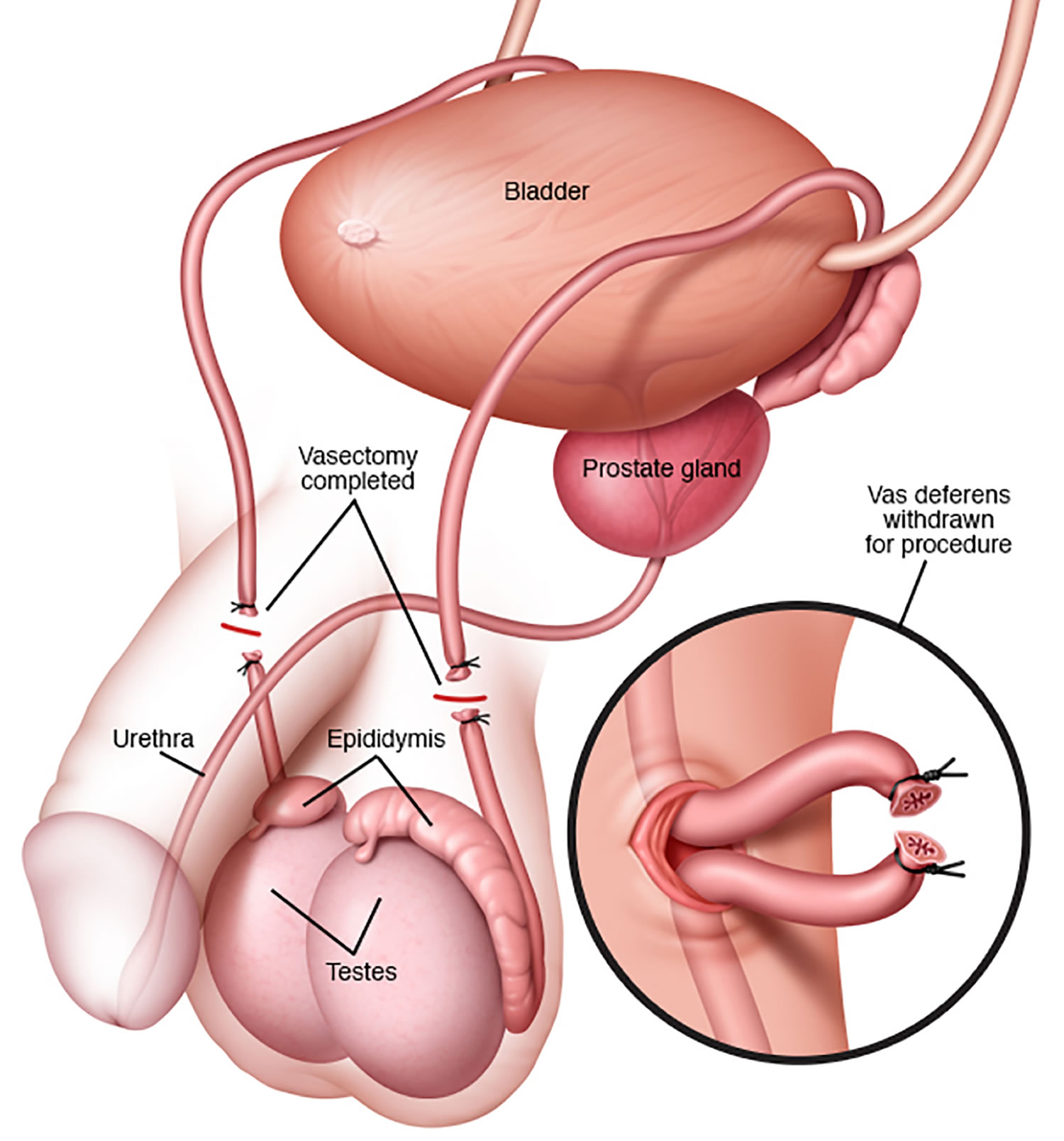 Vasectomy - Recovery, Effectiveness, Reversal and Side Effects