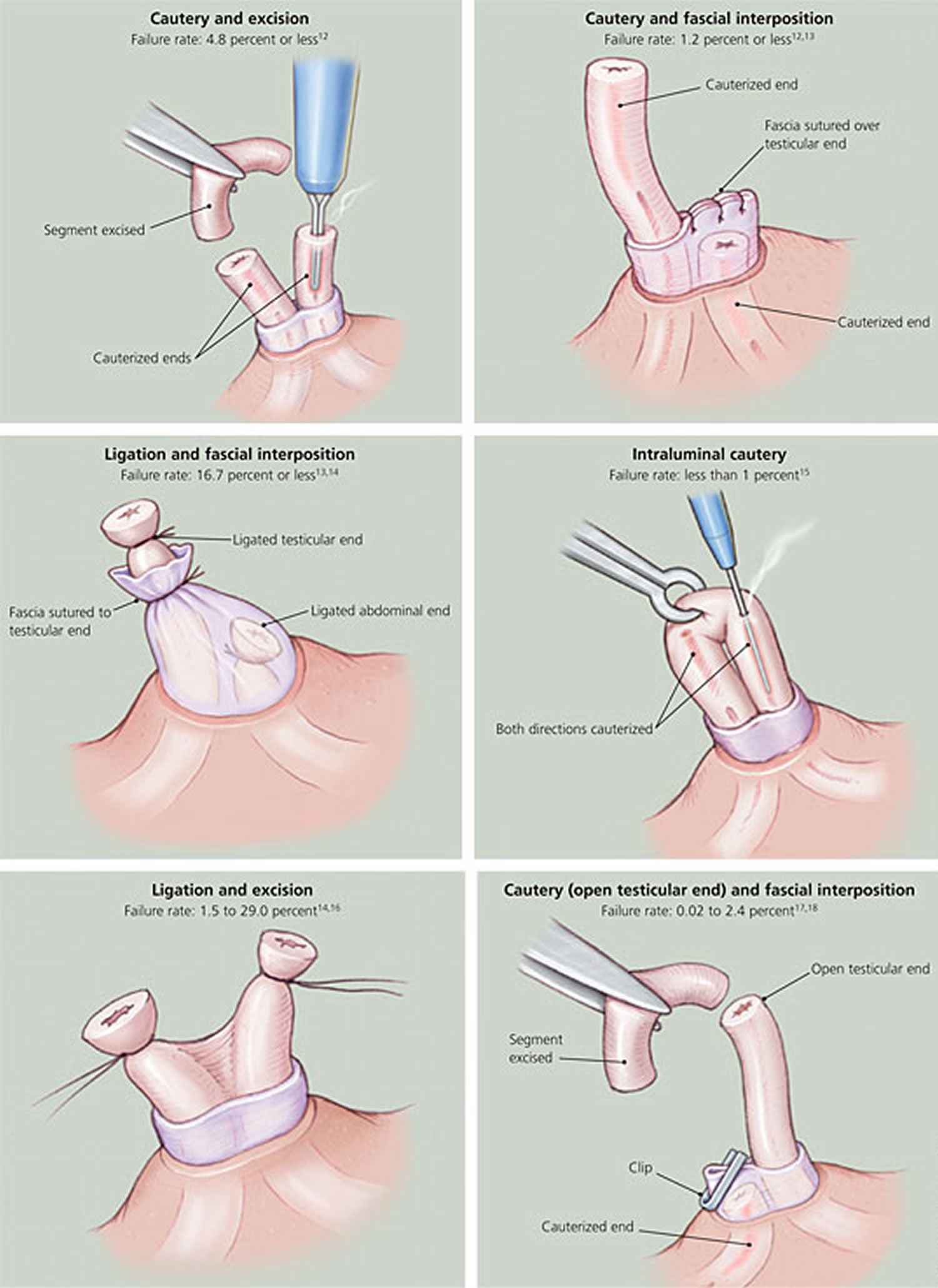 Vasectomy Recovery Effectiveness Reversal and Side Effects