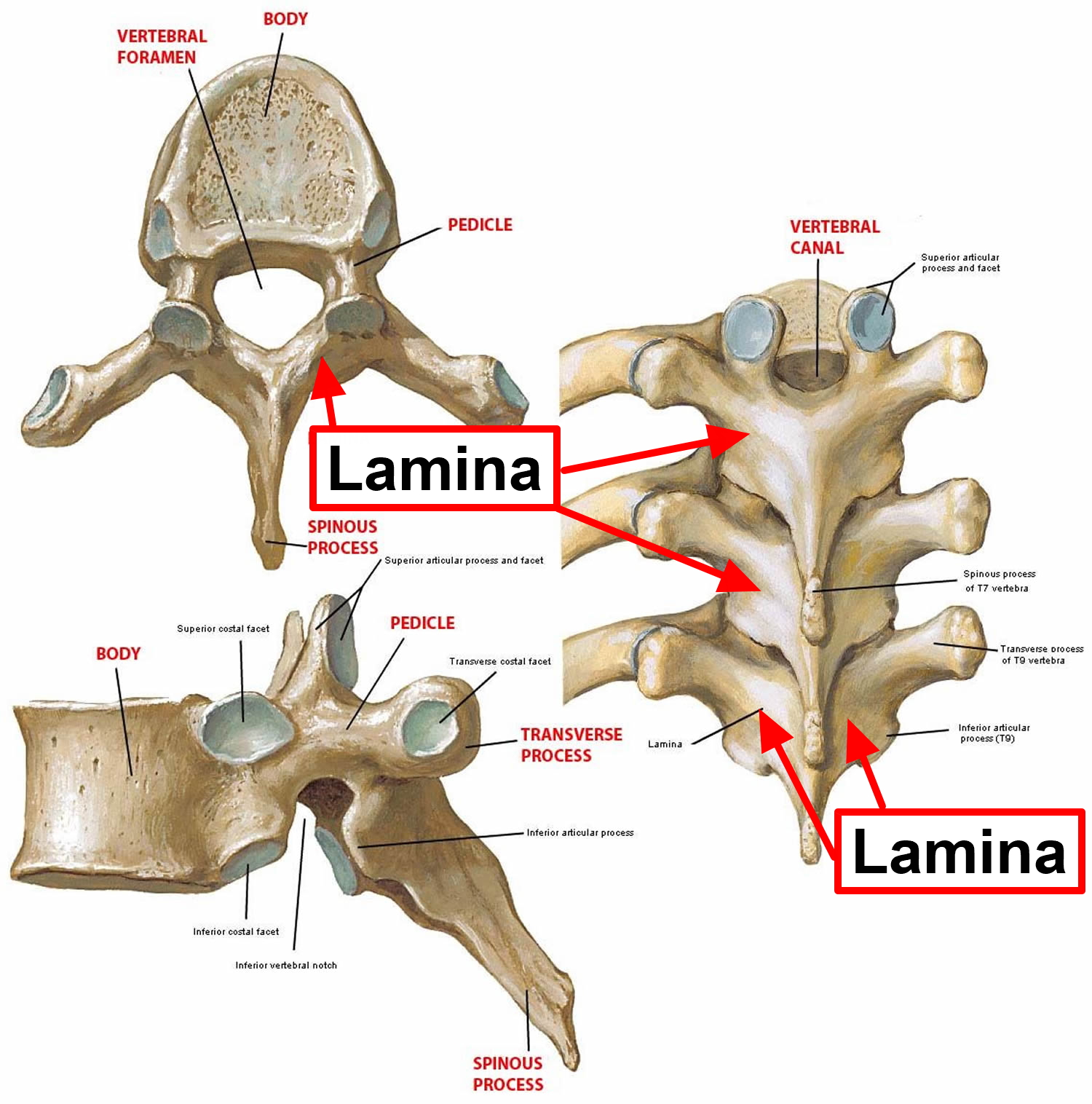 laminectomy