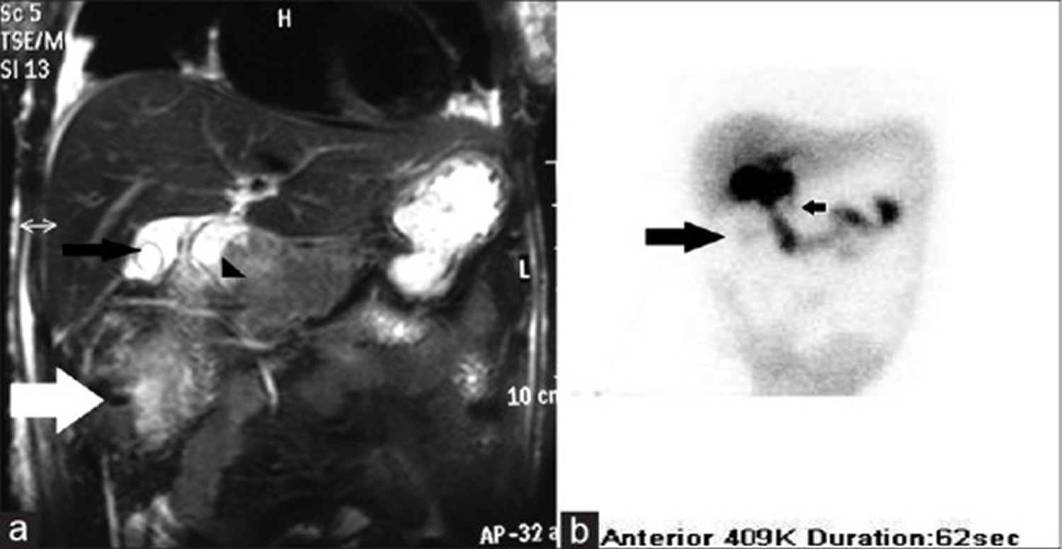 HIDA scan of a patient with bile leak