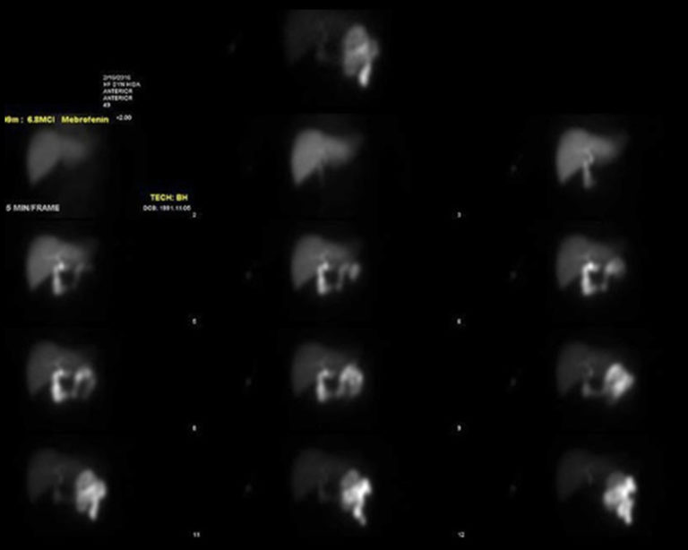 HIDA Scan Procedure - Scan Results, Scan Side Effects