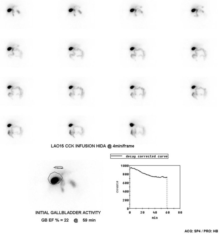 HIDA Scan Procedure - Scan Results, Scan Side Effects