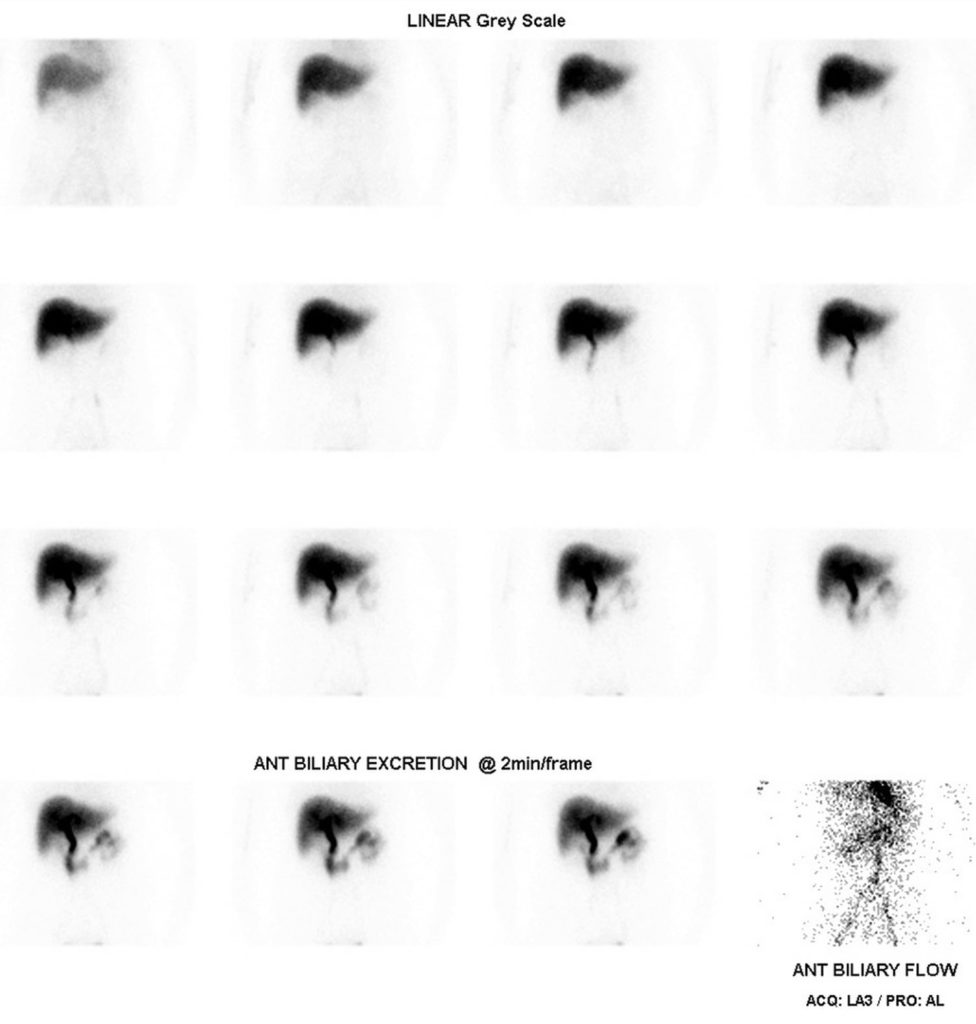 HIDA Scan Procedure - Scan Results, Scan Side Effects