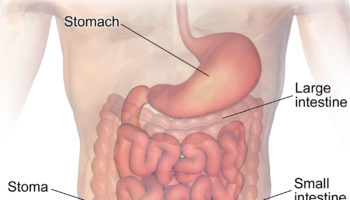 Ileostomy