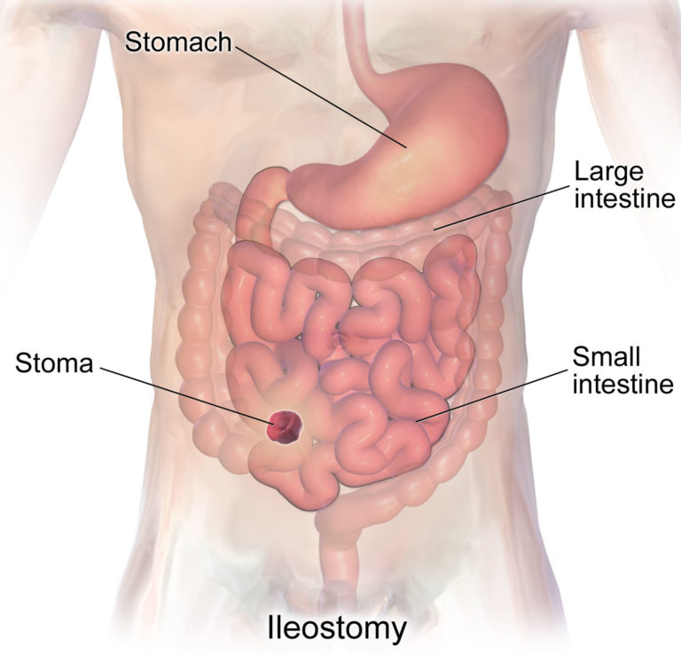 ileostomy-loop-ileostomy-end-ileostomy-diet-complications