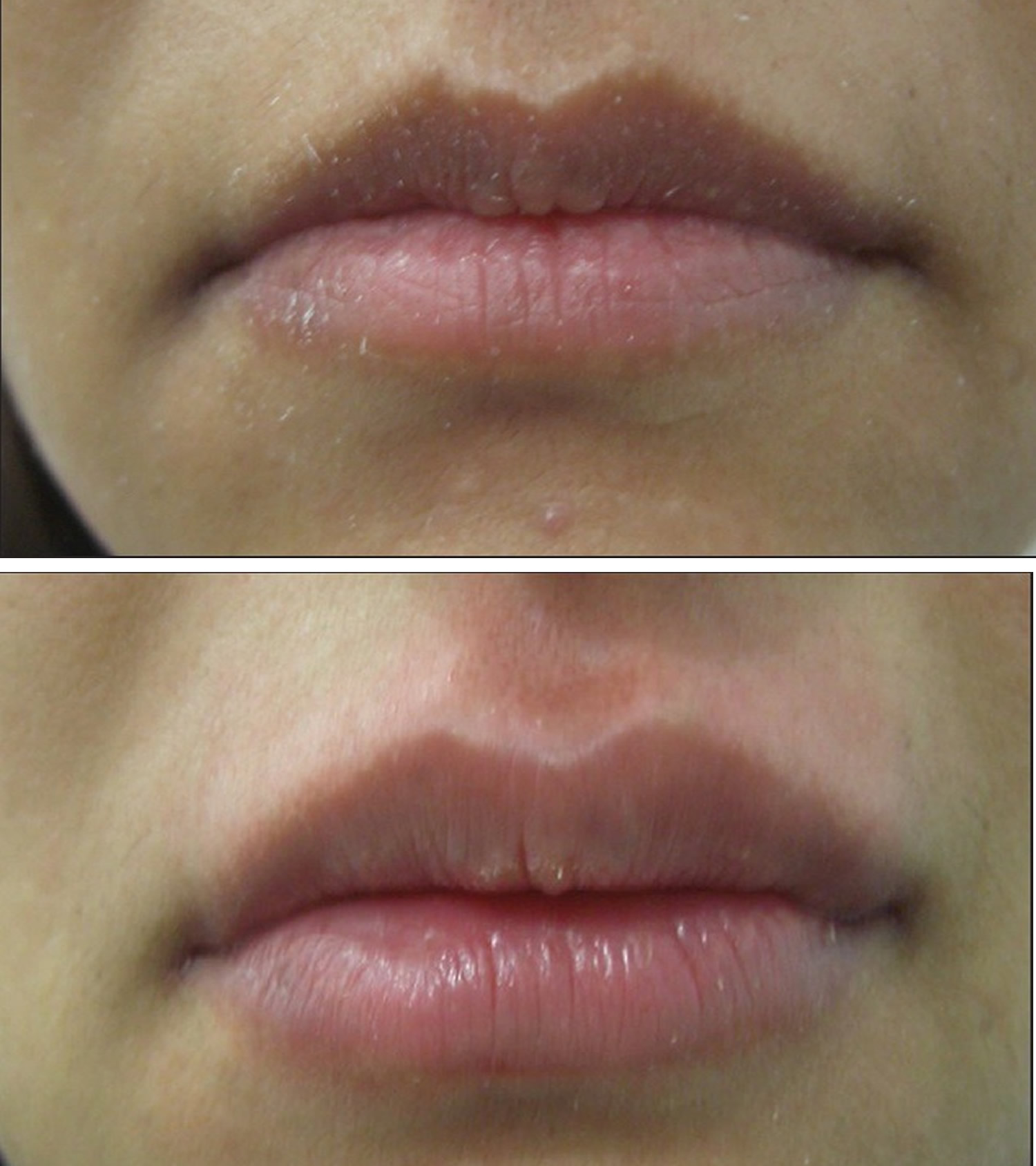 Collection 98 Pictures Before And After Lip Filler Pictures Full Hd 2k 4k 3765