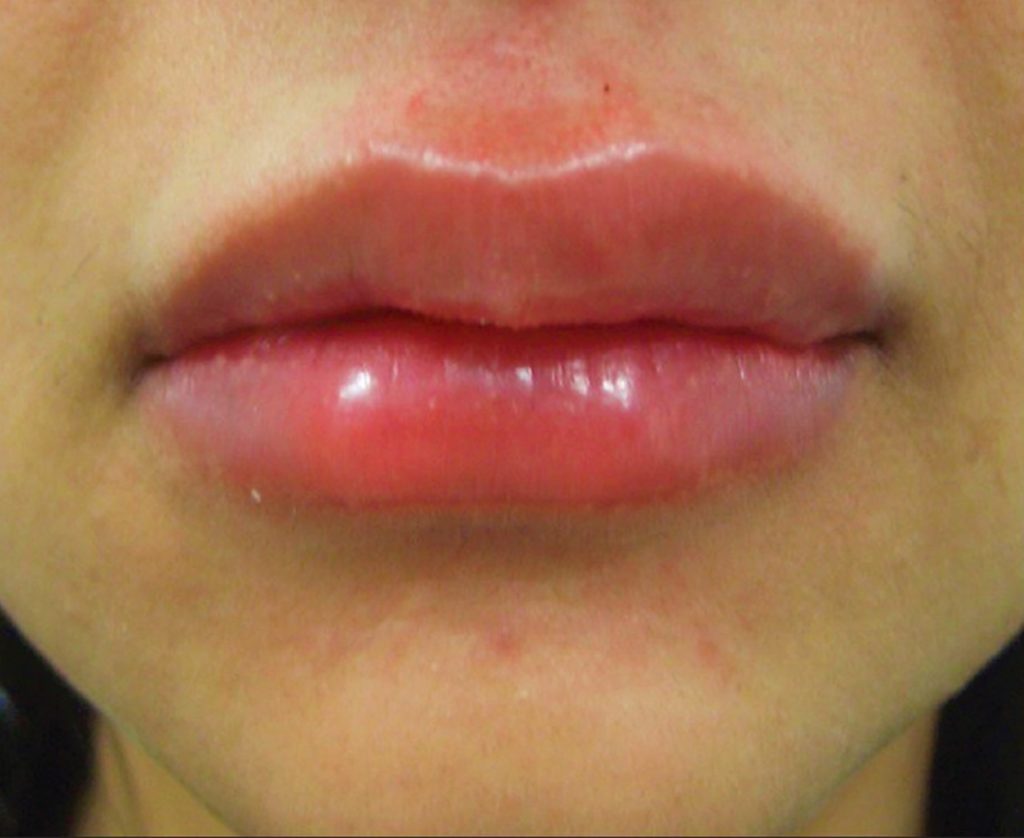 Lip Injections Lip Augmentation Types Of Lip Dermal Fillers Safety