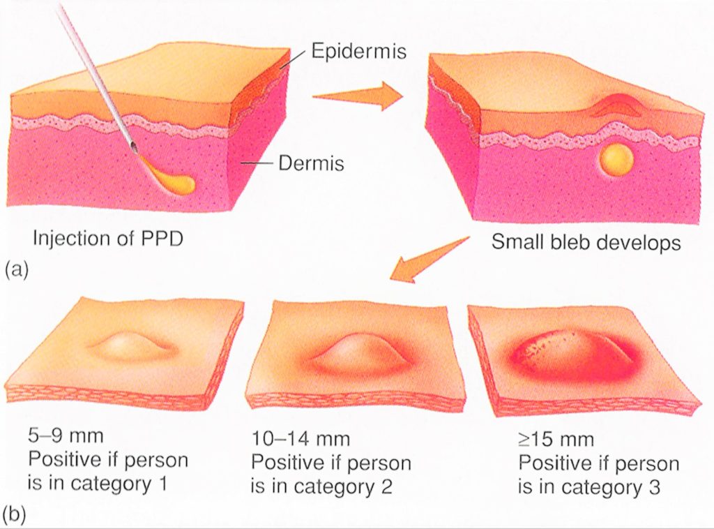 Tuberculosis Test PPD Skin Test, Blood Test, How It Work