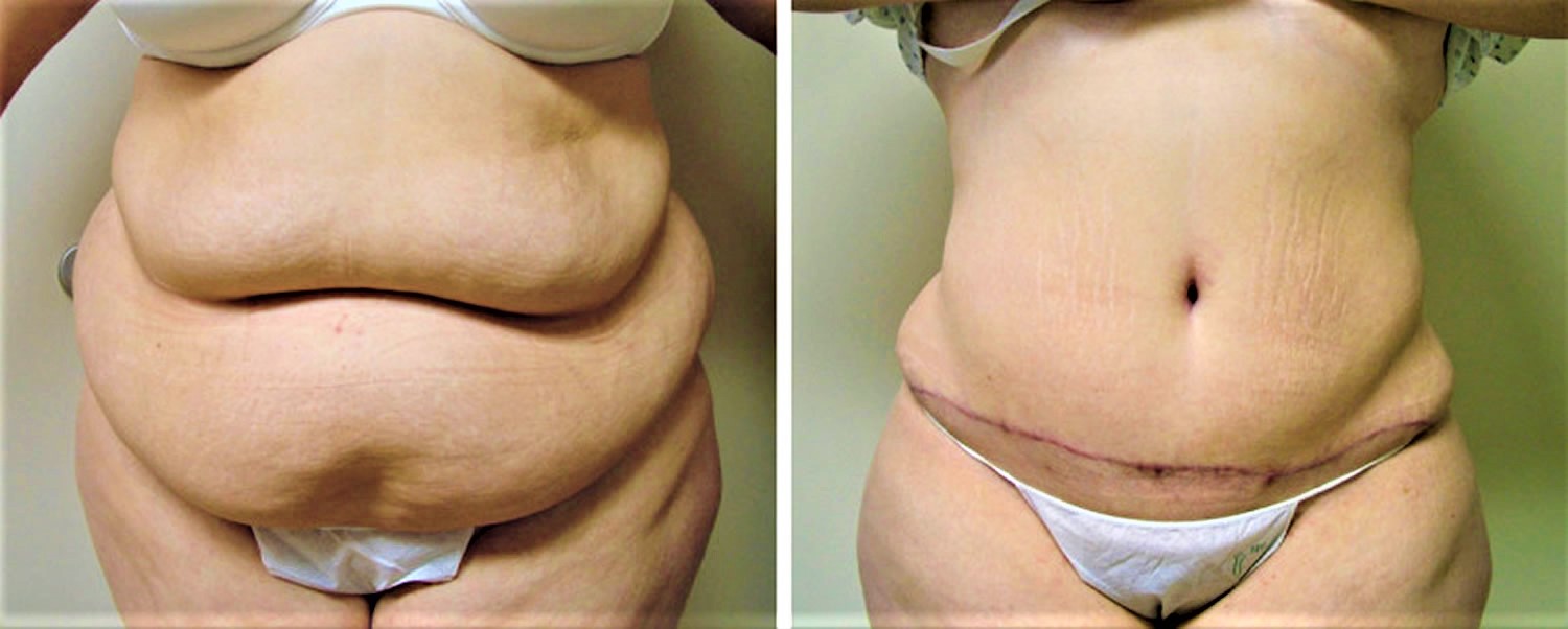 Severe Diastasis Recti (2 kids 10 yrs apart), vs 1 month post op (Tummy  Tuck/Abdominoplasty) 🖤 : r/PlasticSurgery