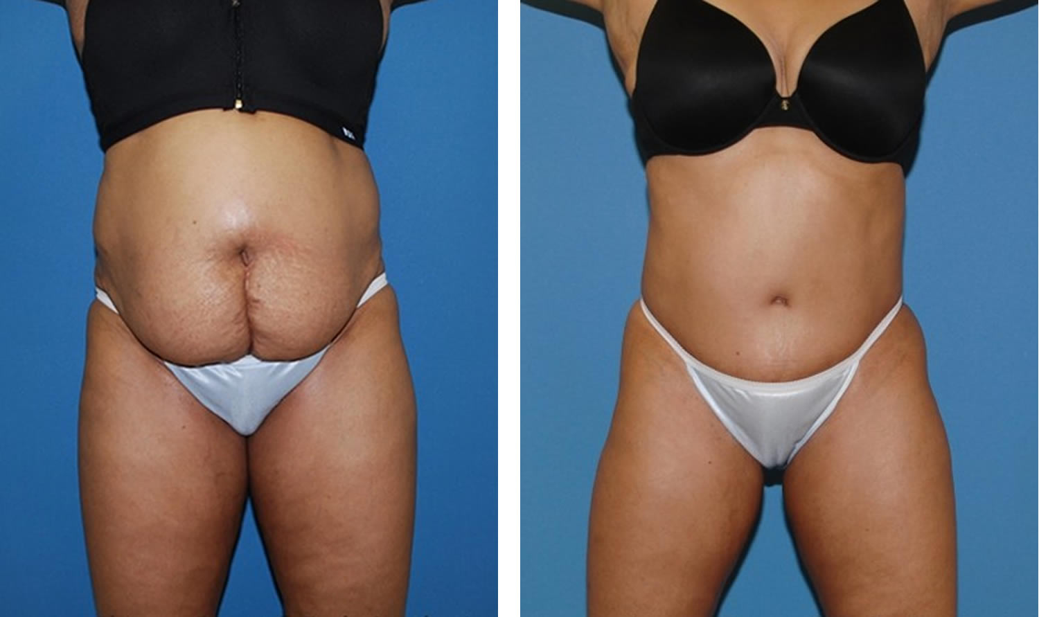 Week 2 post op follow up after double reverse abdominoplasty for isola