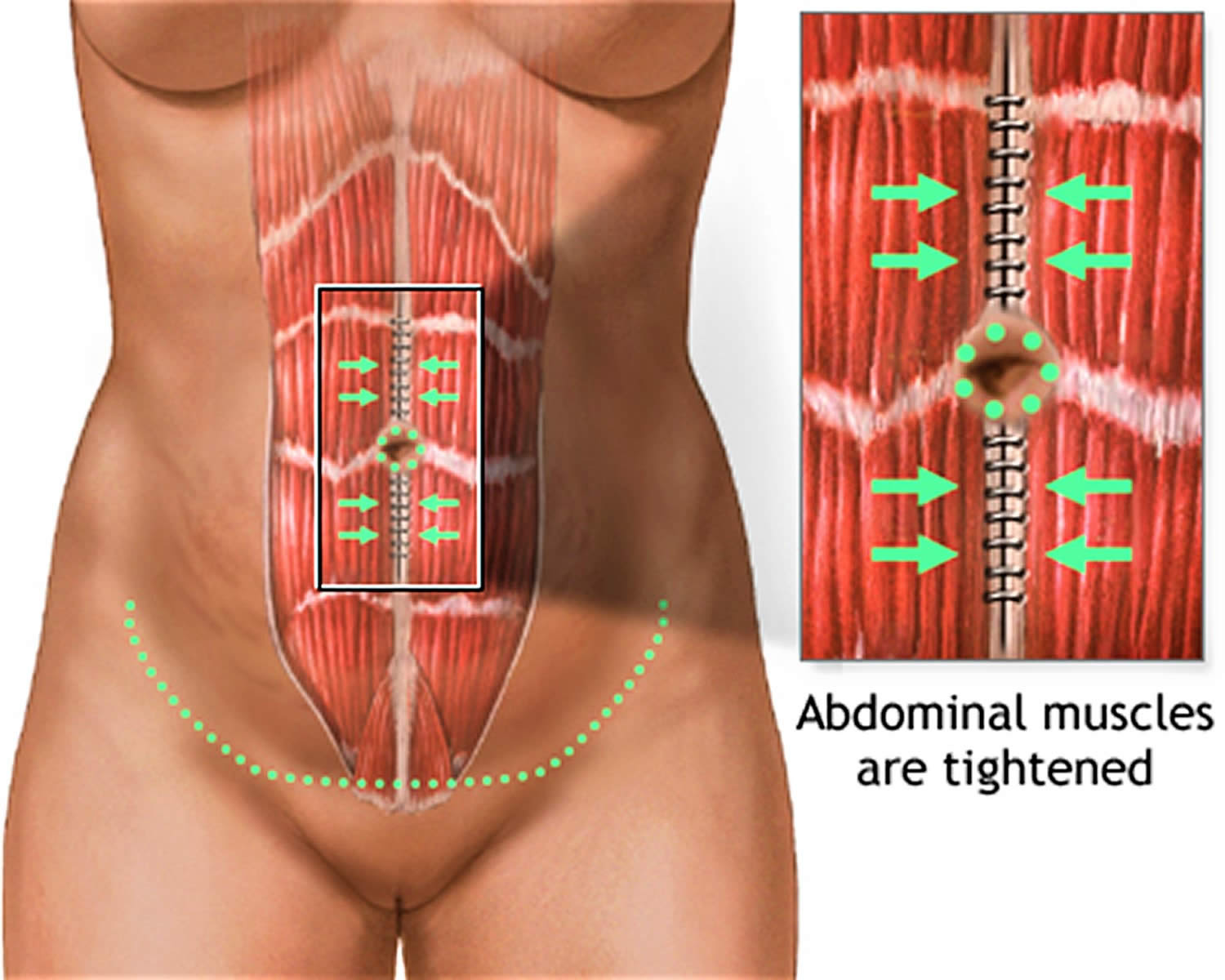 Patient K - 4 weeks Post-Operative Tummy Tuck and Sub-muscular