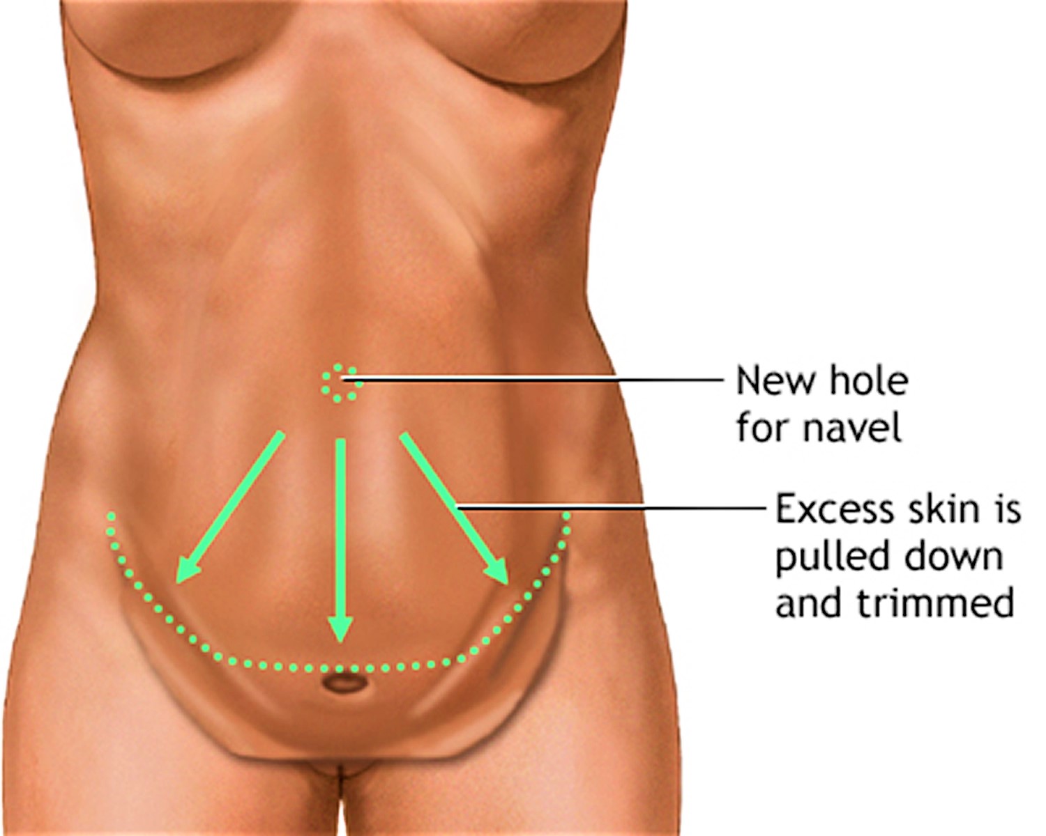 abdominoplasty surgery